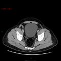 Ampullary carcinoma (Radiopaedia 56396-63056 C 89).jpg