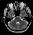 Amyotrophic lateral sclerosis (Radiopaedia 5373-7134 Axial T2 7).jpg