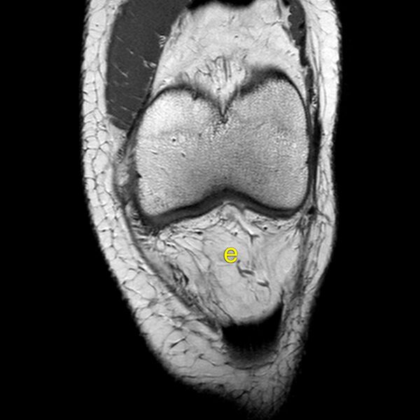 File:Anatomy Quiz (MRI knee) (Radiopaedia 43478-46874 A 7).jpeg