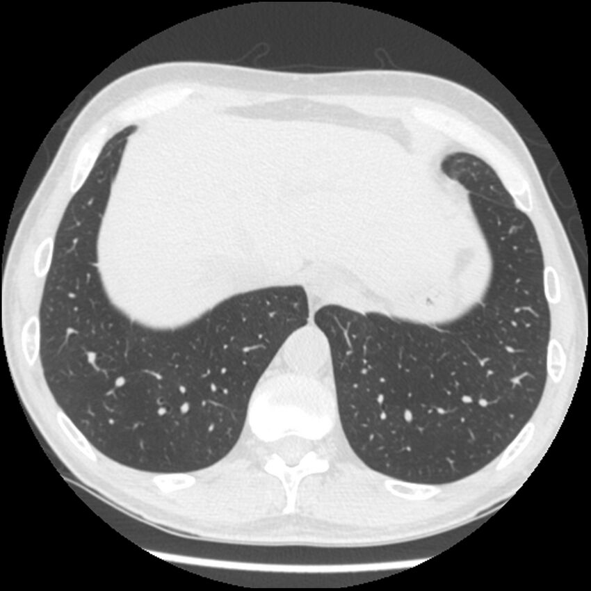 Angioinvasive aspergillosis (Radiopaedia 43957-47466 Axial lung window 57).jpg