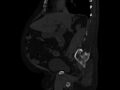 Ankylosing spondylitis (Radiopaedia 44609-48357 Sagittal bone window 40).jpg