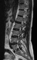 Ankylosing spondylitis - Andersson lesion (Radiopaedia 81878-95838 Sagittal T2 9).jpg