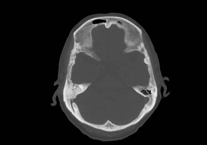 File:Anomalous intracranial venous drainage (Radiopaedia 28161-28418 Axial bone window 12).jpg