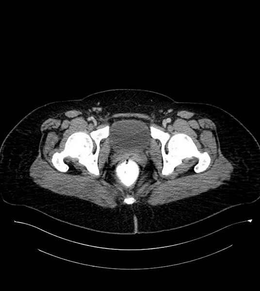 File:Anterior abdominal wall CSF pseudocyst (CSFoma) (Radiopaedia 79453-92571 A 89).jpg