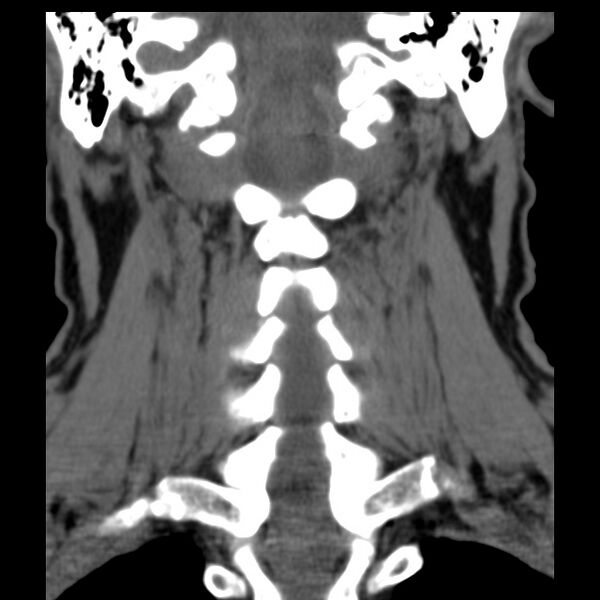 File:Anterior cervical postdiscectomy arthrodesis (Radiopaedia 32678-33646 Coronal non-contrast 22).jpg