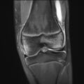 Anterior cruciate ligament tear - pediatric (Radiopaedia 62152-70260 Coronal PD fat sat 14).jpg