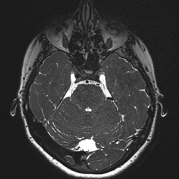 File:Anterior temporal encephalocele (Radiopaedia 82624-96808 Axial T2 high res 47).jpg