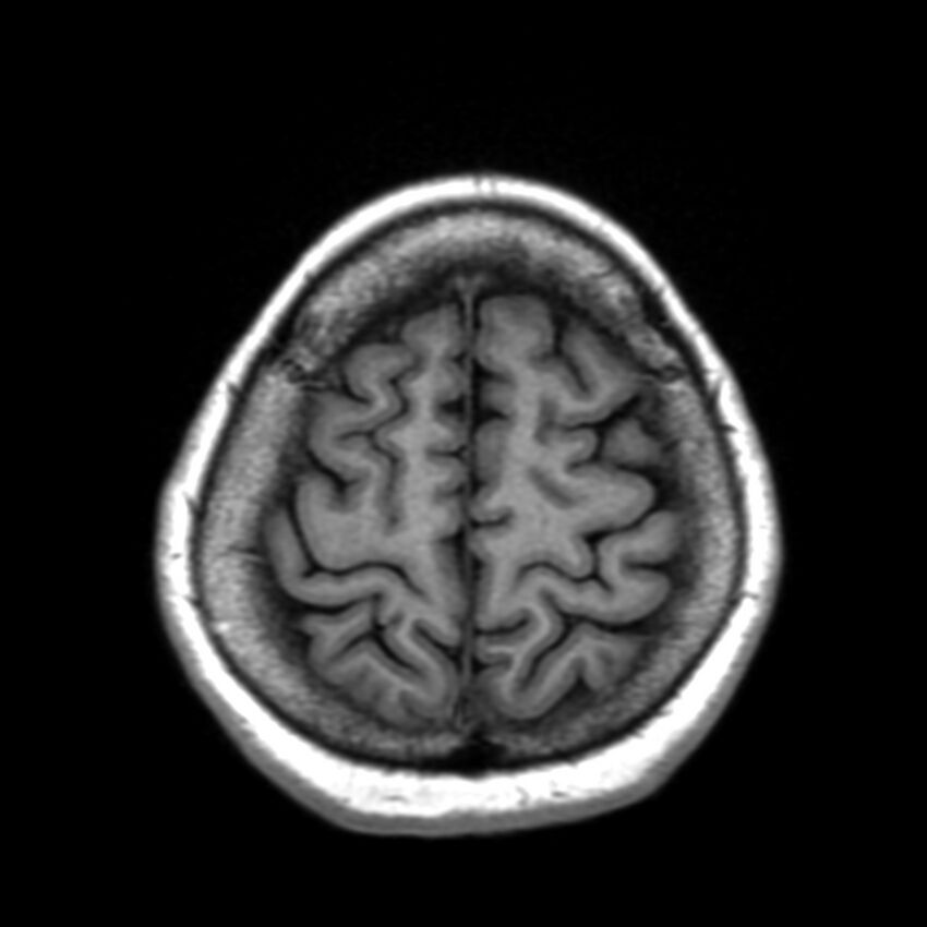 Anti-MOG encephalomyelitis (Radiopaedia 73831-84646 Axial T1 42).jpg