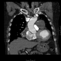 Aorto-coronary bypass graft aneurysms (Radiopaedia 40562-43157 B 16).png