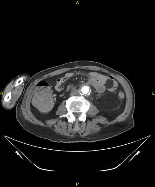 File:Aortoenteric fistula (Radiopaedia 84308-99603 B 208).jpg