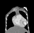 Aortopulmonary window, interrupted aortic arch and large PDA giving the descending aorta (Radiopaedia 35573-37074 D 8).jpg