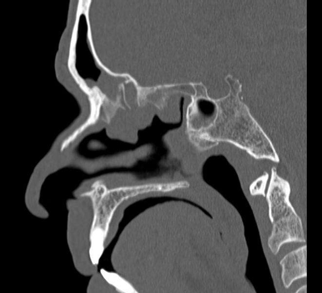 File:Aplastic maxillary sinuses (Radiopaedia 60030-67561 Sagittal bone window 14).jpg