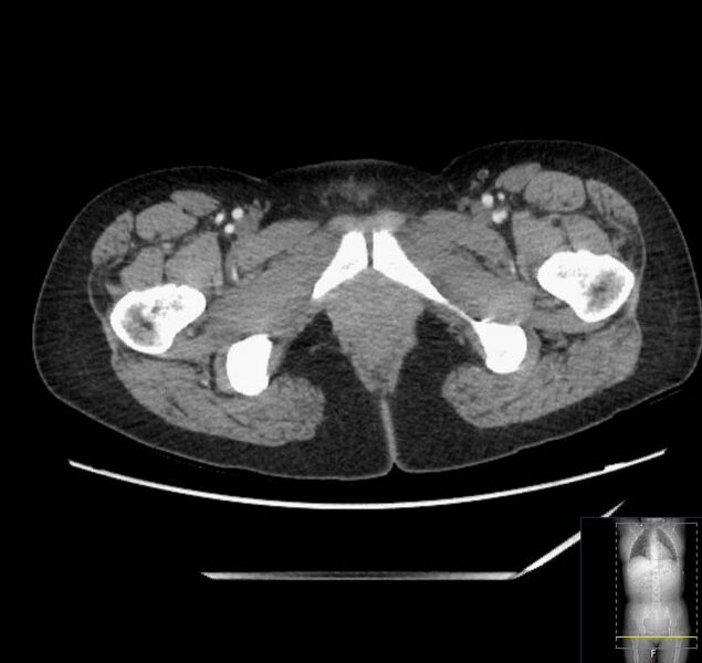 File:Appendicitis (CT angiogram) (Radiopaedia 154713-127660 Axial 98).jpg