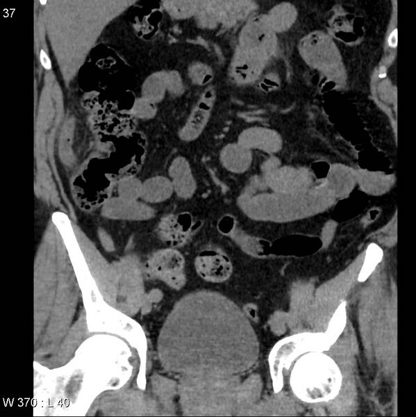 File:Appendicitis (Radiopaedia 12510-12733 Coronal non-contrast 7).jpg