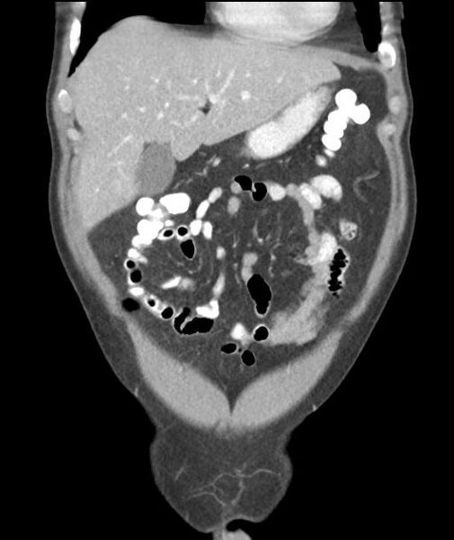 File:Appendicitis with cecal bar sign (Radiopaedia 31878-32830 A 19).jpg