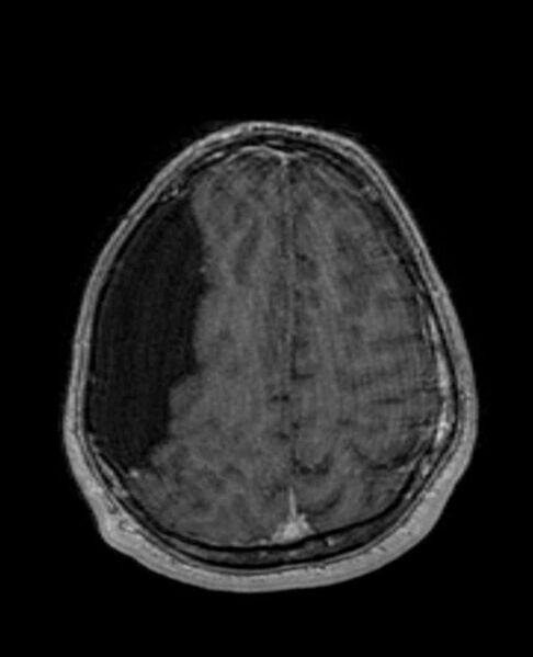 File:Arachnoid cyst- extremely large (Radiopaedia 68741-78451 Axial T1 C+ 63).jpg