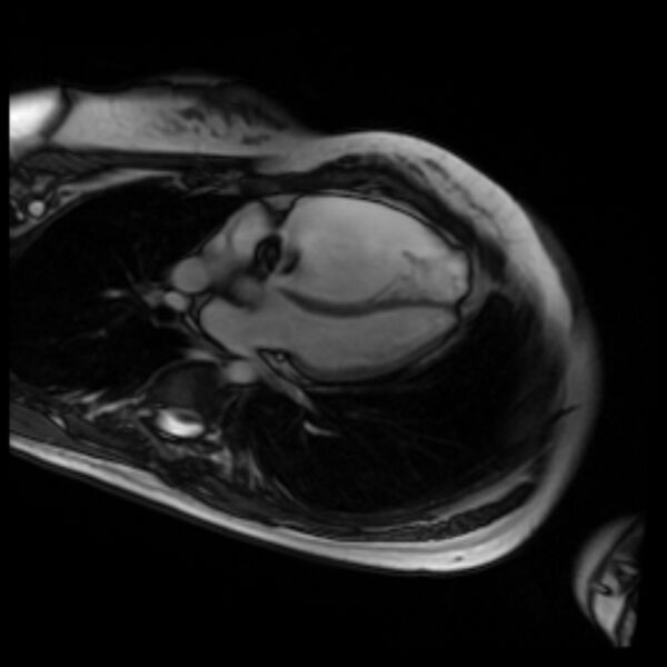 File:Arrhythmogenic right ventricular cardiomyopathy (Radiopaedia 87505-103850 4ch Cine SSFP 57).jpg