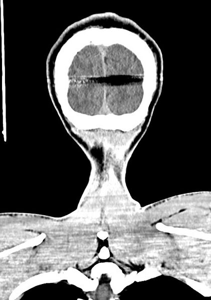 File:Arrow injury to the brain (Radiopaedia 72101-82607 Coronal non-contrast 66).jpg