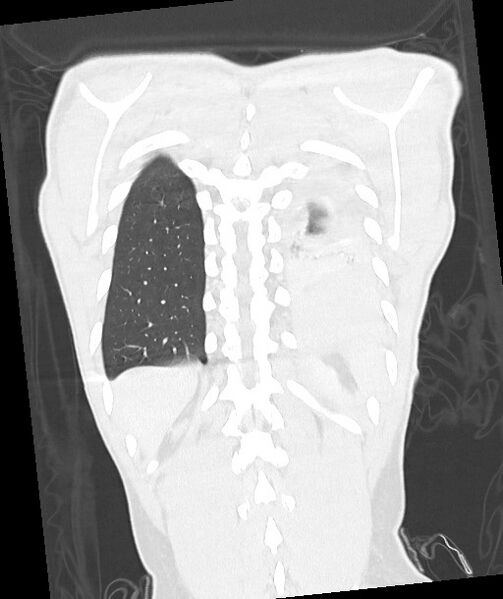 File:Arrow injury to the chest (Radiopaedia 85367-100975 Coronal lung window 108).jpg
