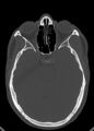 Arrow injury to the head (Radiopaedia 75266-86388 Axial bone window 62).jpg
