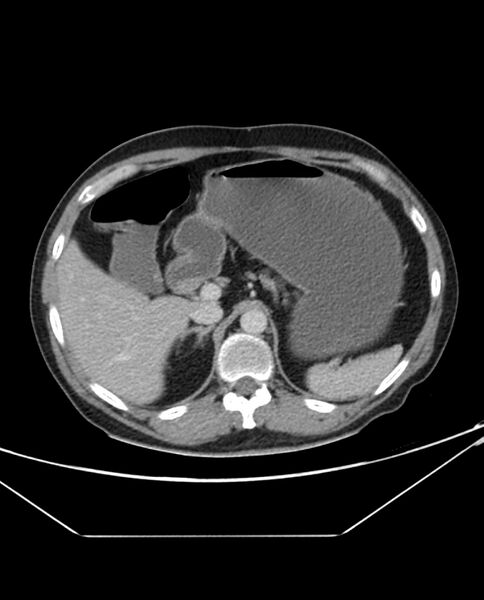 File:Arterial occlusive mesenteric ischemia (Radiopaedia 84641-100054 A 32).jpg