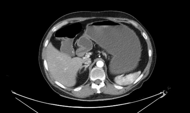File:Arterial occlusive mesenteric ischemia (Radiopaedia 84641-100060 A 41).jpg