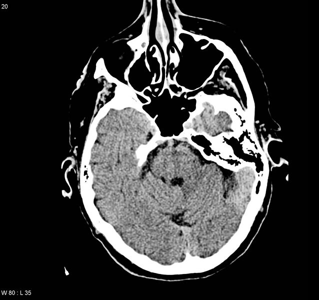 File:Arteriovenous malformation - cerebral (Radiopaedia 8172-9020 Axial non-contrast 5).jpg