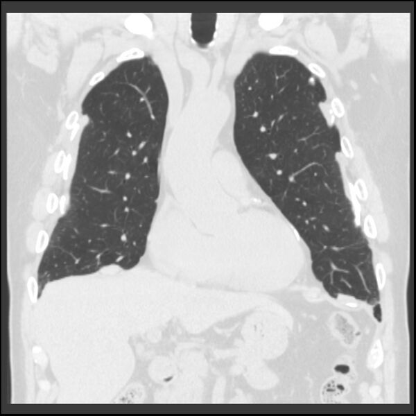File:Asbestos-related pleural plaques (Radiopaedia 39069-41255 Coronal lung window 59).jpg