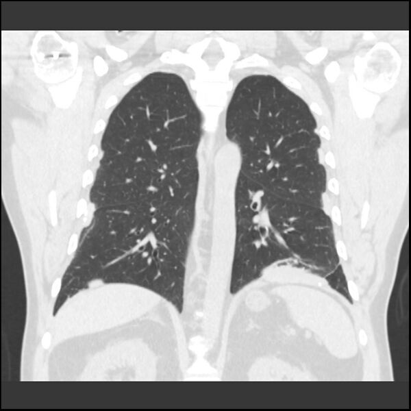 File:Asbestosis (Radiopaedia 45002-48961 Coronal lung window 3).jpg