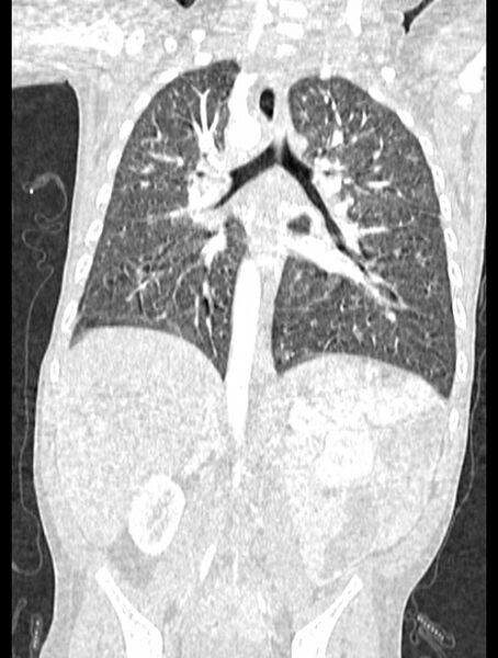 File:Asplenia syndrome (Radiopaedia 73083-83792 Coronal lung window 87).jpg
