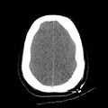 Atlanto-occipital dislocation (Radiopaedia 44648-48412 Axial non-contrast 44).jpg