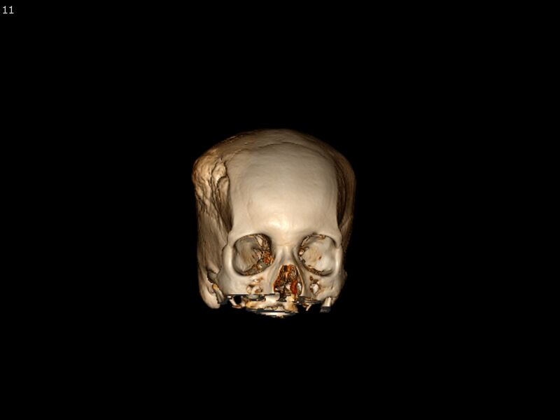 File:Atypical meningioma - intraosseous (Radiopaedia 64915-73867 3D volume render 11).jpg