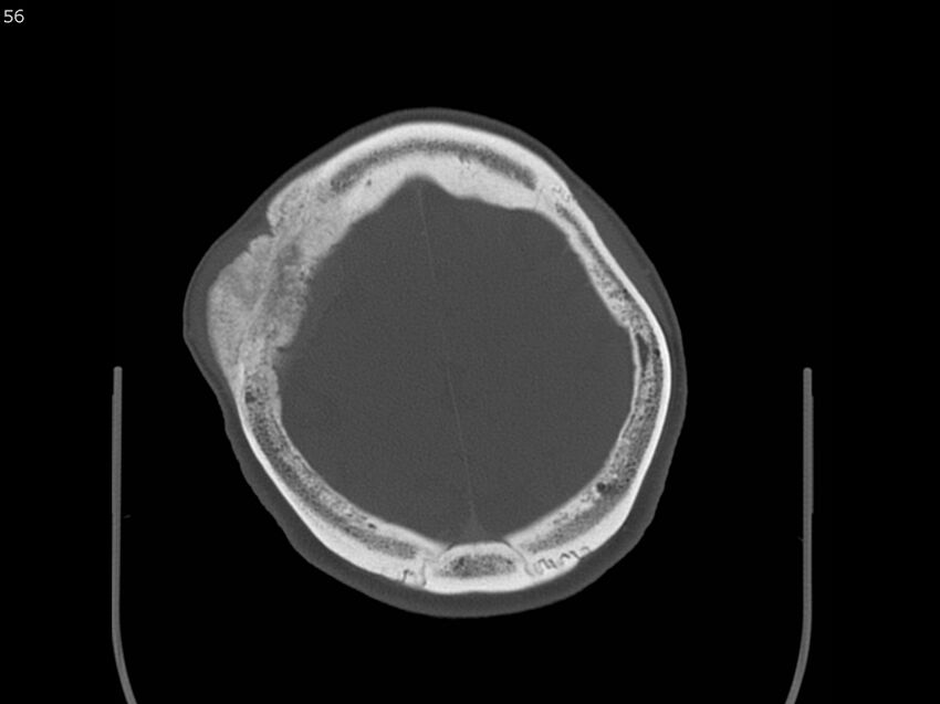Atypical meningioma - intraosseous (Radiopaedia 64915-73867 Axial C+ bone window 56).jpg