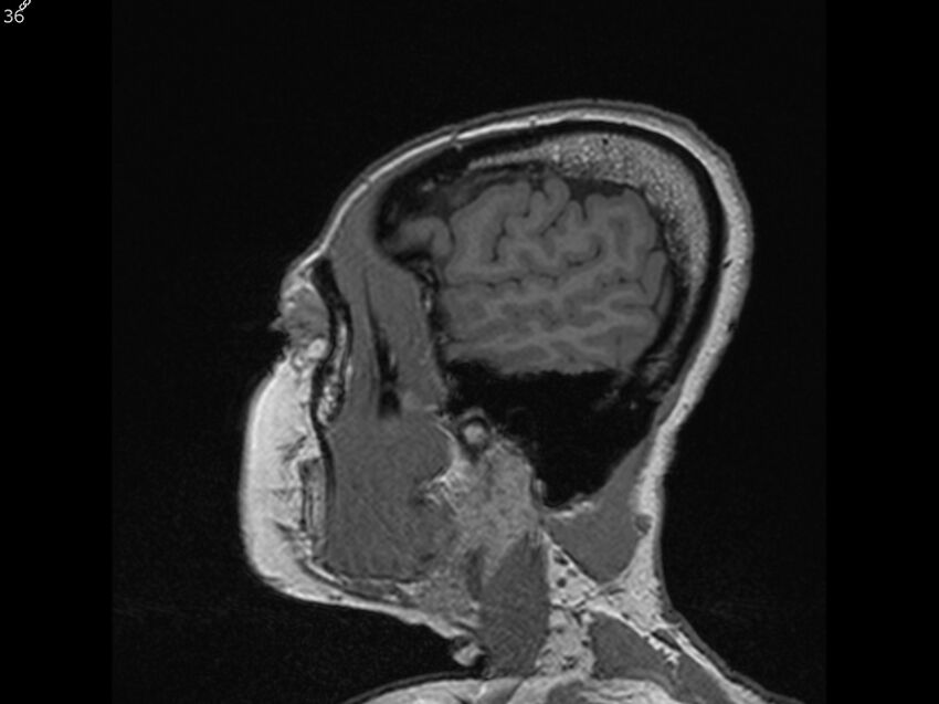 Atypical meningioma - intraosseous (Radiopaedia 64915-74572 Sagittal T1 36).jpg