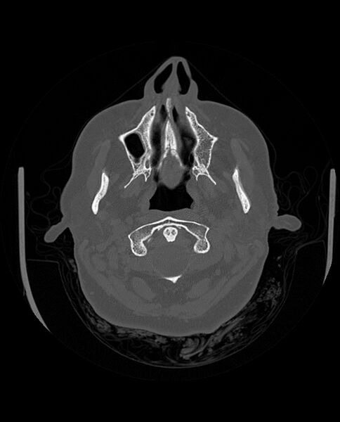 File:Automastoidectomy with labyrinthine fistula (Radiopaedia 84143-99411 Axial non-contrast 43).jpg