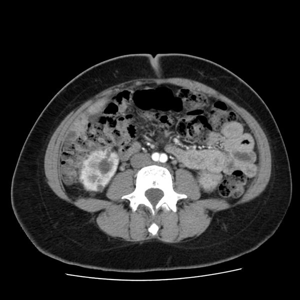 File:Autosomal dominant polycystic kidney disease (Radiopaedia 23061-23093 B 40).jpg