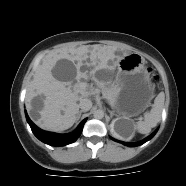 File:Autosomal dominant polycystic kidney disease (Radiopaedia 23061-23093 C+ delayed 18).jpg