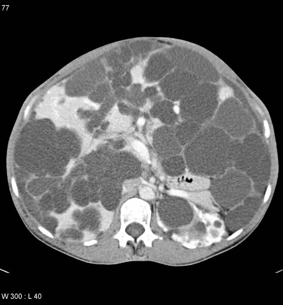 File:Autosomal dominant polycystic kidney disease with extensive hepatic involvement (Radiopaedia 5204-6971 B 9).jpg
