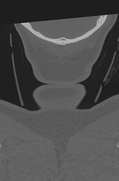 File:Axis peg fracture (type 3) and atlas lateral mass (type 4) fracture (Radiopaedia 37474-39324 Coronal bone window 74).png