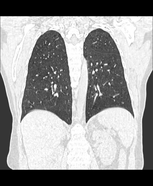 File:Azygos fissure and azygos lobe (Radiopaedia 41841-44832 Coronal lung window 15).jpg