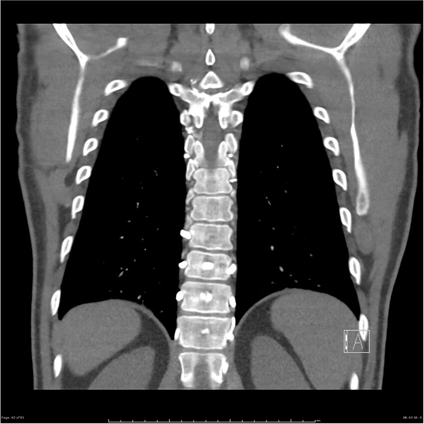 Azygos venous system anatomy (CT pulmonary angiography) (Radiopaedia 25928-26077 Coronal C+ CTPA 62).jpg