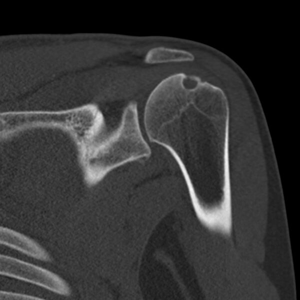 File:Bankart lesion (Radiopaedia 22771-22798 Coronal bone window 24).jpg