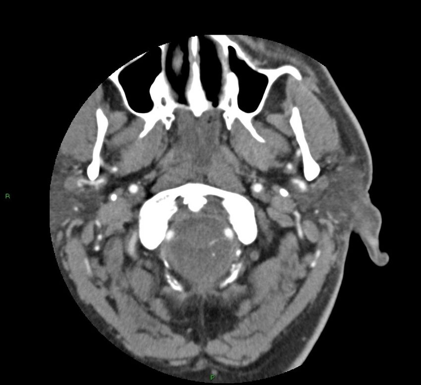Basal ganglia hemorrhage (Radiopaedia 58763-65985 D 10).jpg
