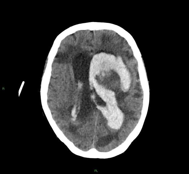 File:Basal ganglia hemorrhage (Radiopaedia 58766-65988 Axial non-contrast 29).jpg