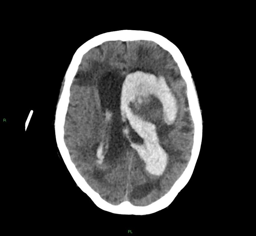 Basal ganglia hemorrhage (Radiopaedia 58766-65988 Axial non-contrast 29).jpg