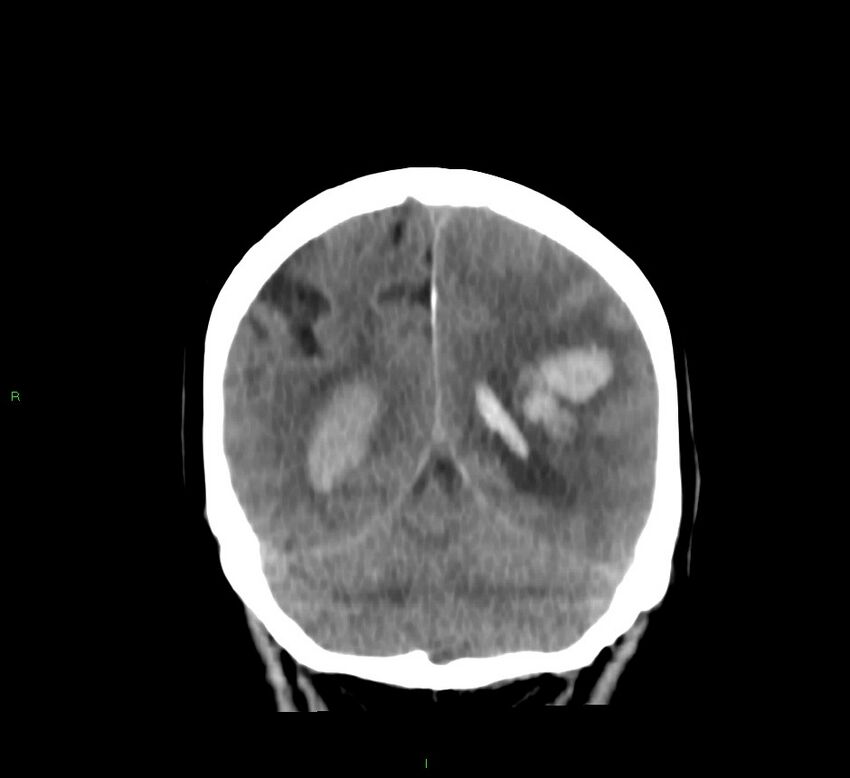 Basal ganglia hemorrhage (Radiopaedia 58767-65989 Coronal non-contrast 21).jpg