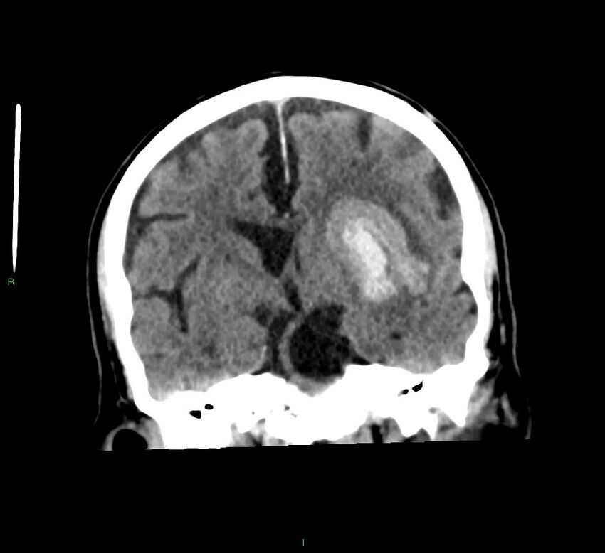 Basal ganglia hemorrhage (Radiopaedia 58791-66025 Coronal non-contrast 35).jpg