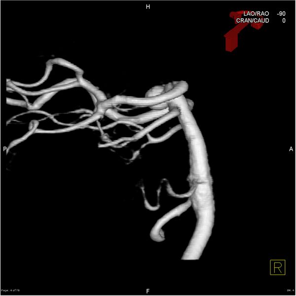 File:Basilar tip aneurysm double balloon remodeling (Radiopaedia 18100-17883 3D rotation 4).jpg