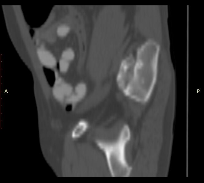File:Bertolotti syndrome (Radiopaedia 58974-66235 Sagittal bone window 53).jpg