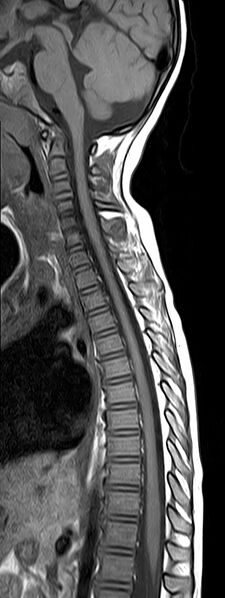 File:Bilateral Sprengel deformity with Klippel-Feil syndrome (Radiopaedia 66395-75650 Sagittal T1 7).jpg